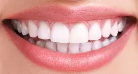 بلیچینگ دندان