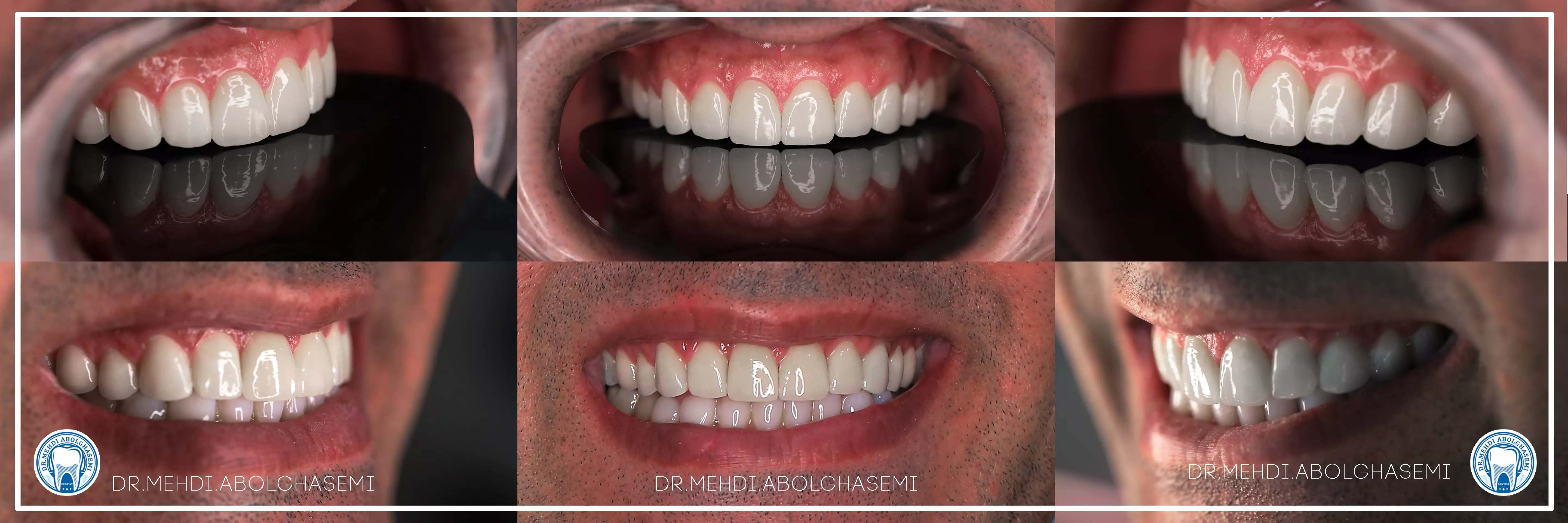 تصاویر لامینیت سرامیکی