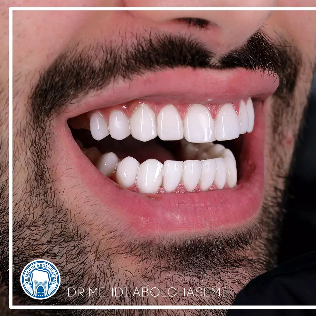 تصاویر کامپوزیت ونیر