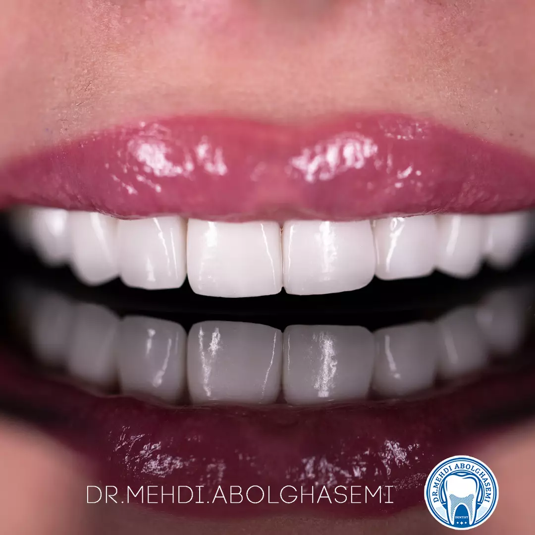 تصاویر لامینیت سرامیکی