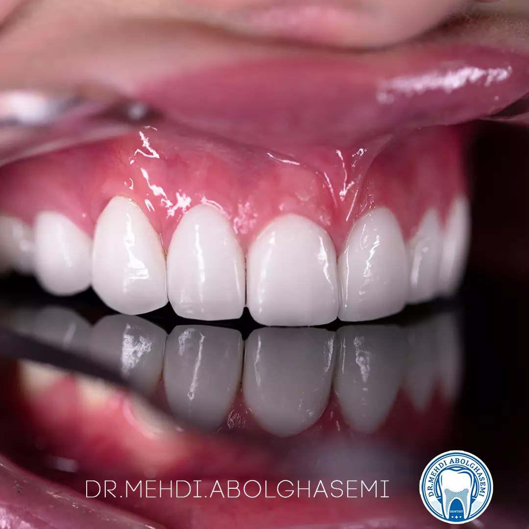 تصاویر لامینیت سرامیکی