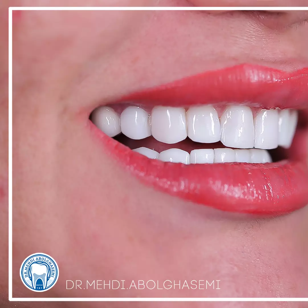 تصاویر کامپوزیت ونیر