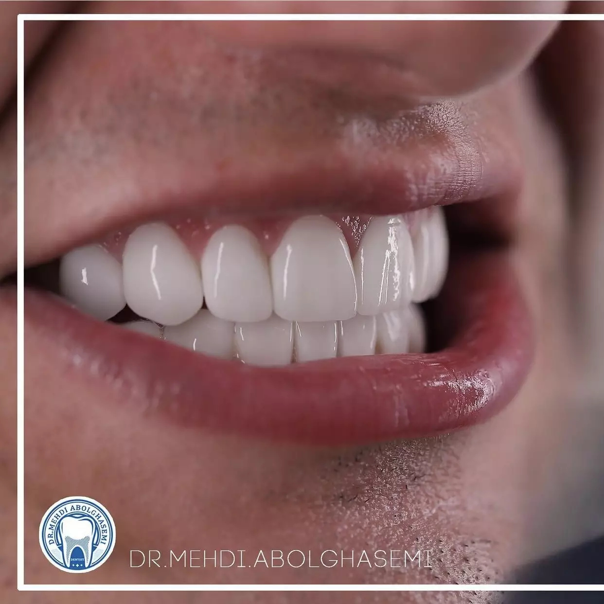 تصاویر کامپوزیت ونیر