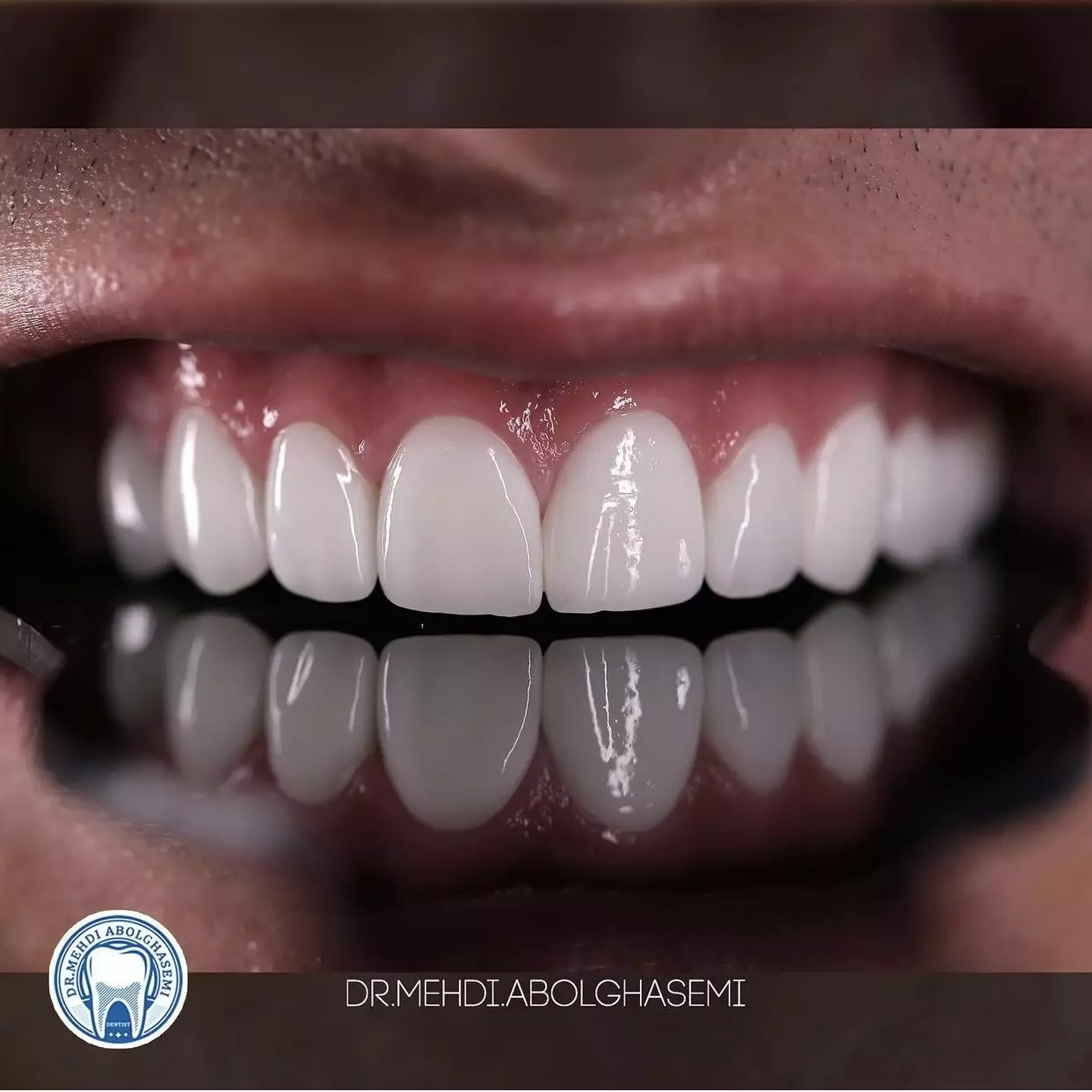 تصاویر کامپوزیت ونیر