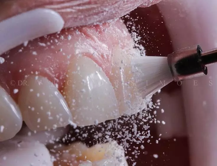 جرم گیری دندان