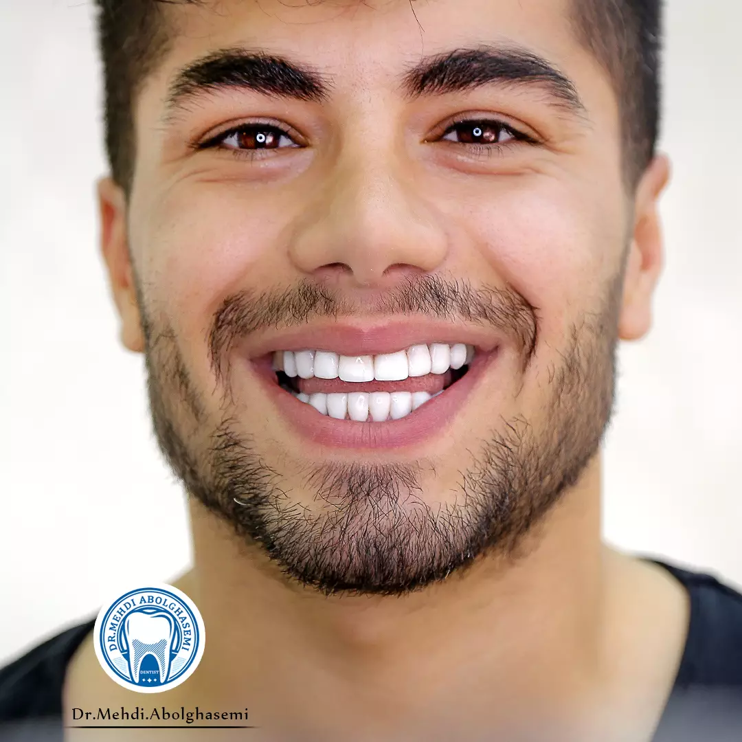 تصاویر کامپوزیت ونیر