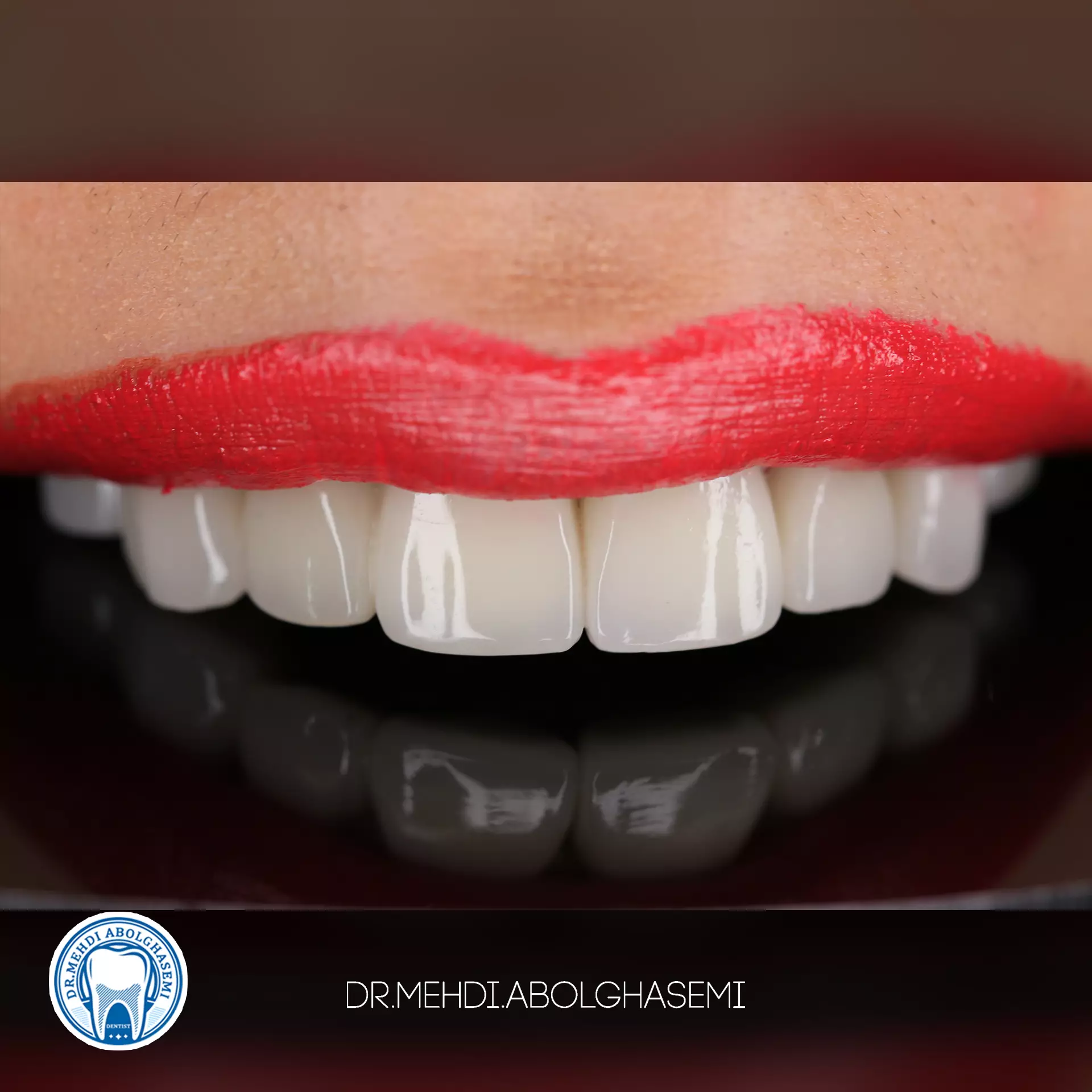 تصاویر لامینیت سرامیکی