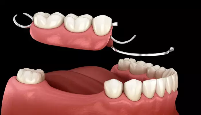 آشنایی-با-پروتز-دندان-ثابت