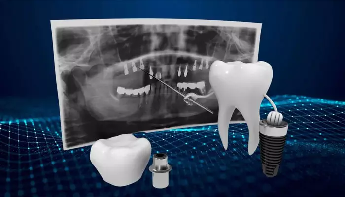 ایمپلنت-دیجیتال-1-روزه