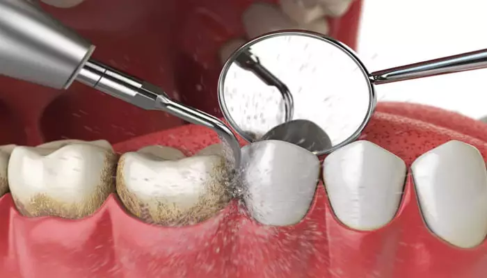 بهترین-زمان-جرمگیری-دندان1