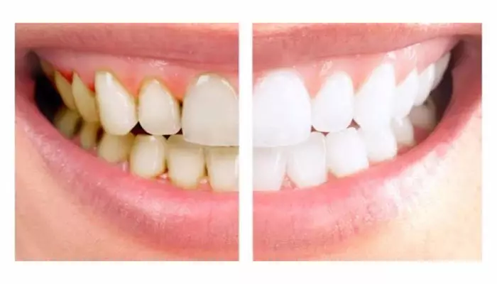 بهترین-زمان-جرمگیری-دندان