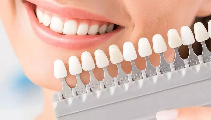 بهترین-نوع-لمینت-دندان