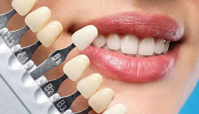 بهترین-نوع-لمینت-دندان1