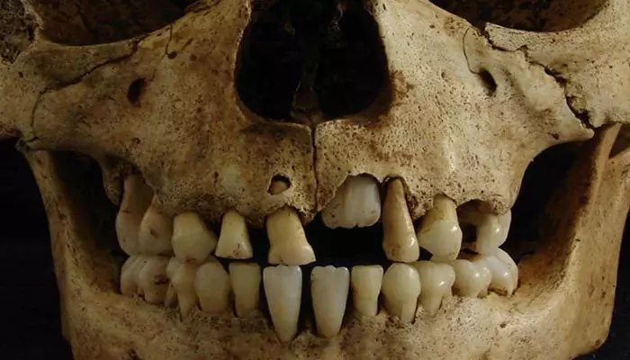 تاریخچه-ایمپلنت-دندان1