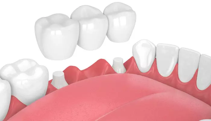 ترمیم-دندان-بدون-تاج