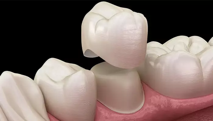 ترمیم-دندان-بدون-تاج2