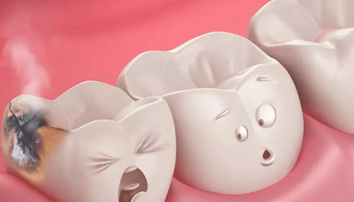 ترمیم-پوسیدگی-دندان