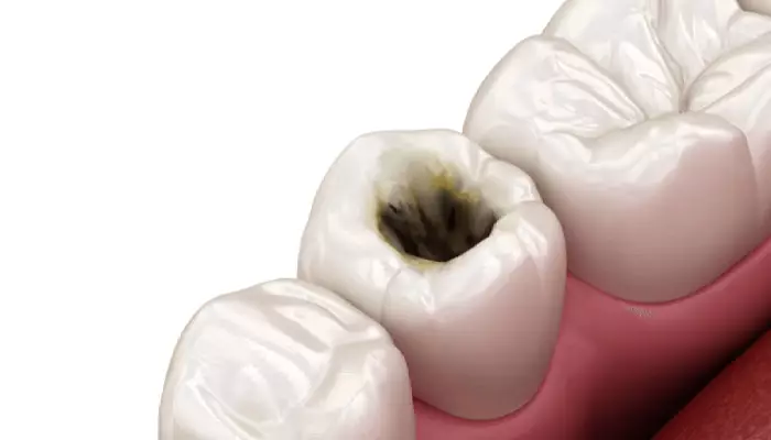 ترمیم-پوسیدگی-دندان2