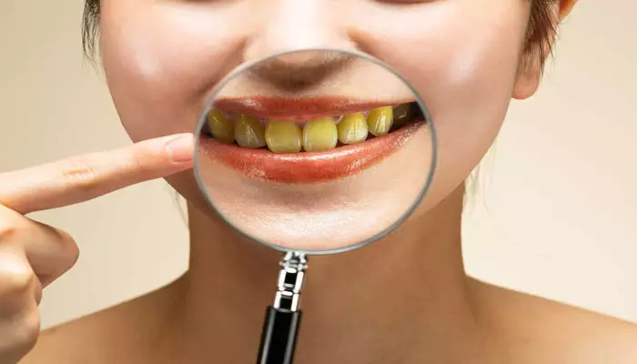 جلوگیری-از-زرد-شدن-دندان-ها1