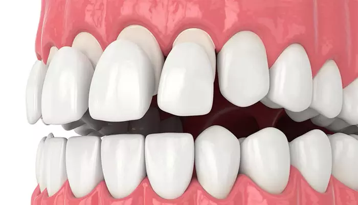 روکش-دندان2