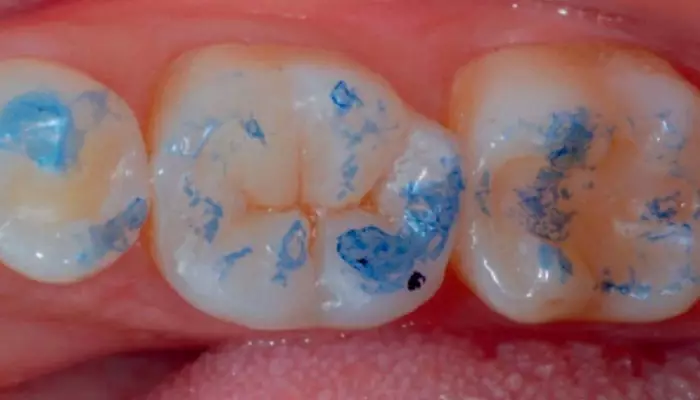 ریختن-کامپوزیت1