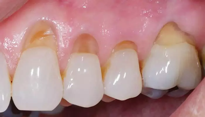 ریختن-کامپوزیت2