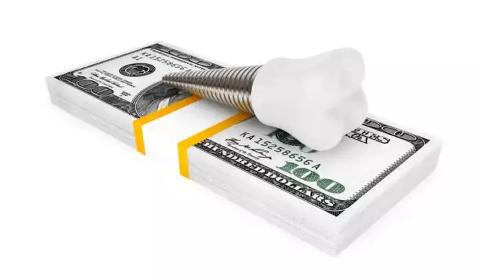 عوامل موثر بر قیمت ایمپلنت دندان