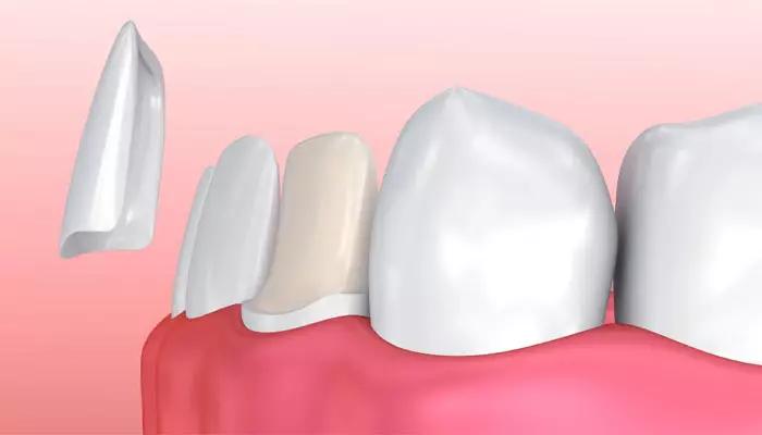 قیمت-روکش-دندان