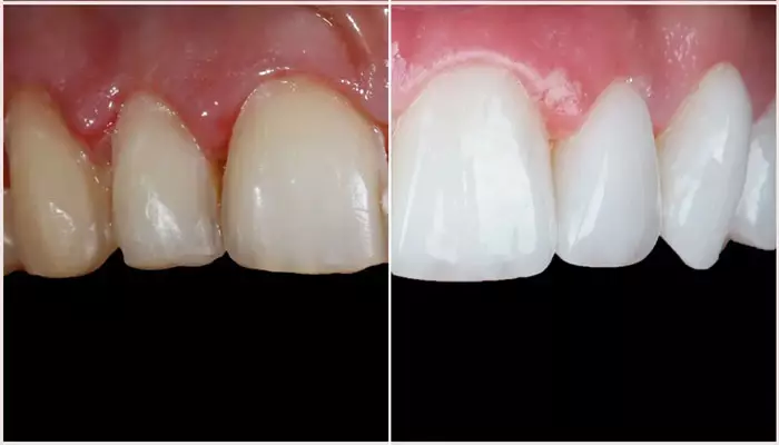 لمینت-دندان1