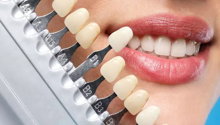 لمینت-دندان2