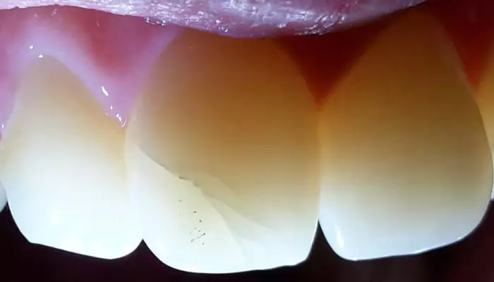 مراقبت-از-دندان-شکسته