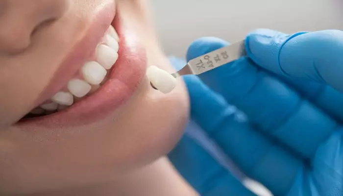 مراقبت-از-روکش-دندان2