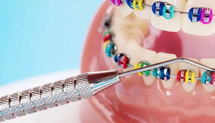 مراقبت-های-بعد-از-ارتودنسی3