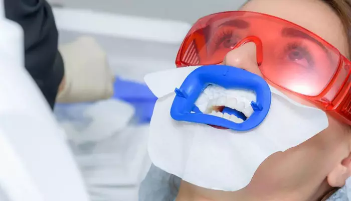 مراقبت-های-بعد-از-بلیچینگ-دندان1