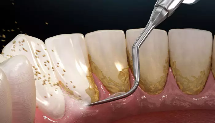 پلاک-دندان1