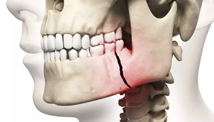 پوکی-استخوان-و-ایمپلنت1