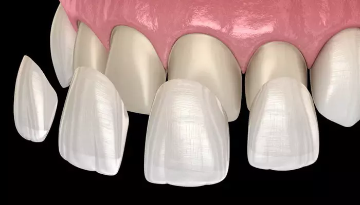 لمینت سرامیکی از انواع لمینت دندان