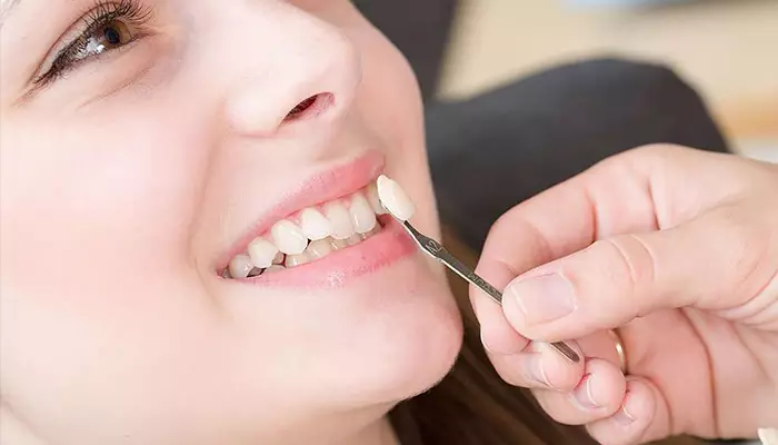 لمینت کامپوزیتی بهتر است یا سرامیکی