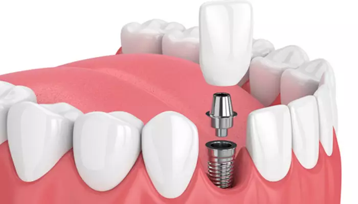 ترمیم دندان با کمک ایمپلنت