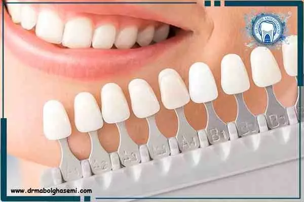 مقدار تراش دندان در لمینت