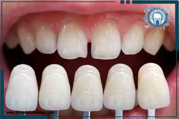 لمینت دندان 