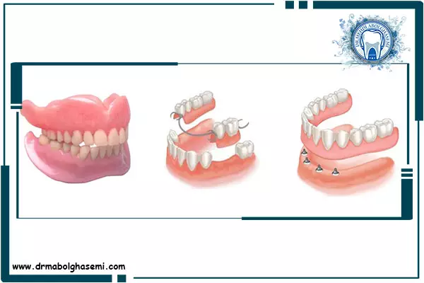 پروتز دندان و انواع آن