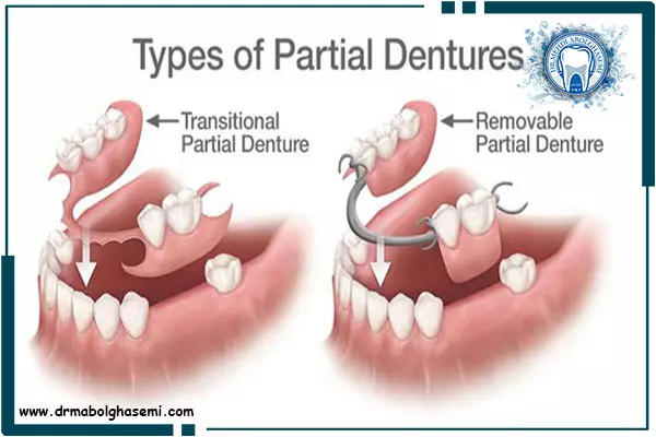 انواع پروتز دندان