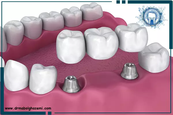 پروتز ثابت دندان