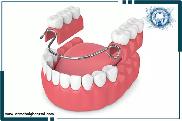 پروتز متحرک دندان