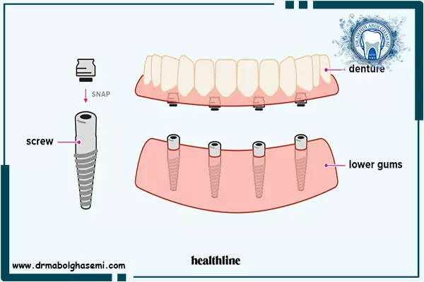 مزایای پروتز دندان