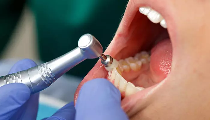 جرمگیری از روش های سفید کردن دندان