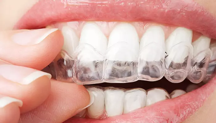 بلیچینگ در منزل