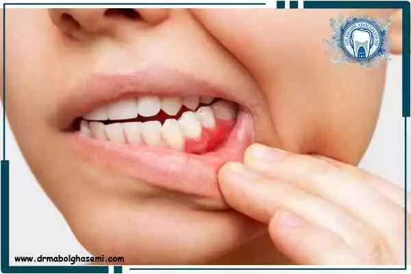 درمان فوری آبسه دندان با روش های خانگی