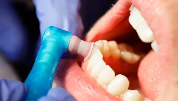 جرمگیری دندان